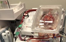 Unikátní transplantace v IKEMu: Srdce mrtvé bije dál!