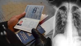 Včasné a povinné rentgenové vyšetření by mohlo upozornit na případnou tuberkulózu. (ilustrační foto)