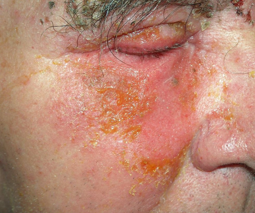 Impetigo mohou mít i dospělí.