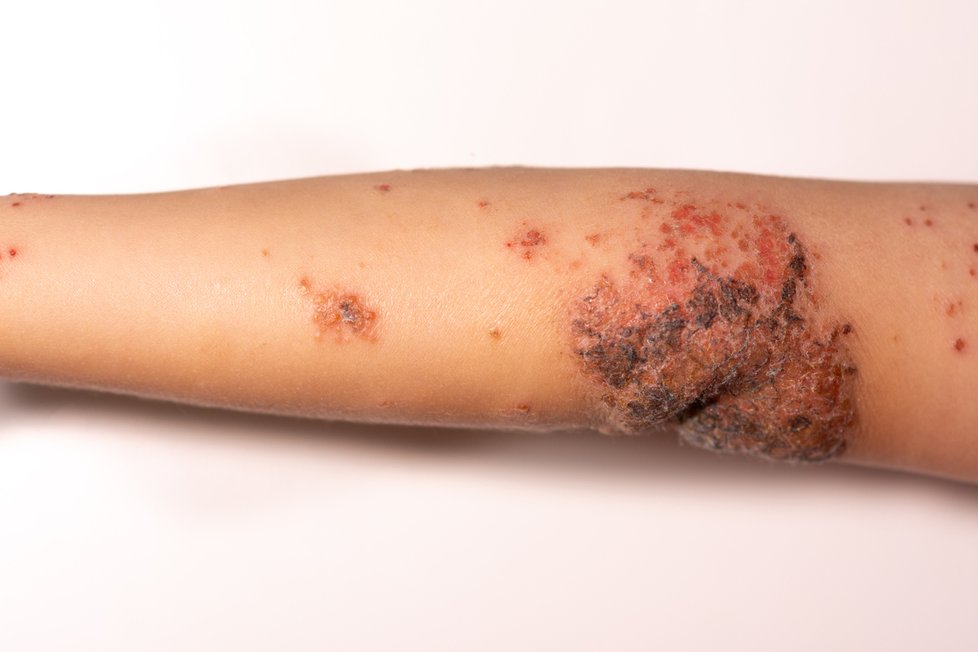 Pokud s impetigem nezajdete k lékaři, může se zkomplikovat.