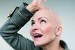 Anna se s rakovinou rozhodla bojovat! Ztráta vlasů je daní za dávky chemoterapie.