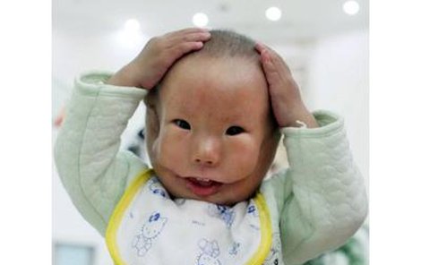 Dítě s maskou. Malý Xiao je pro ostatní děti zrůdou.