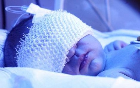 Jaroušek nyní podstupuje kvůli novorozenecké žloutence fototerapii modrým světlem. Musí mít proto přikrytá očička.