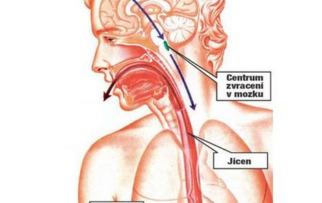 Když se aktivuje centrum zvracení, vyšle signál žaludku a bránici. Ty se společně silně stáhnou a jícnem a ústy odchází problémový obsah žaludku ven z těla.