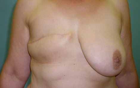 Lékaři museli paní Janě odebrat pravé prso.