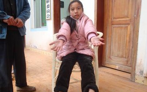 Liu Ya se narodila se 24 prsty.