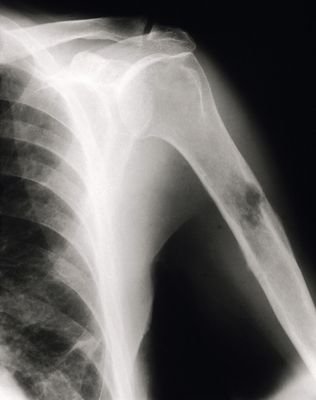 Na rentgenovém snímku je dobře vidět nádor na pažní kosti.
