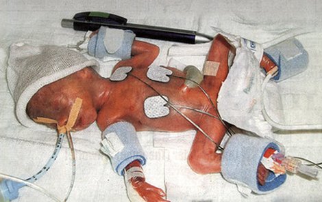Nejmenší holčička Německa měřila po narození pouhých 26 cm.