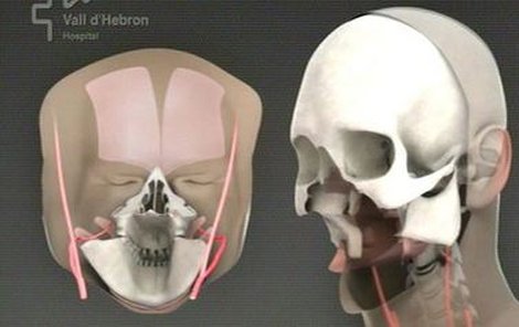 Pacientovi nahradili celý obličej.