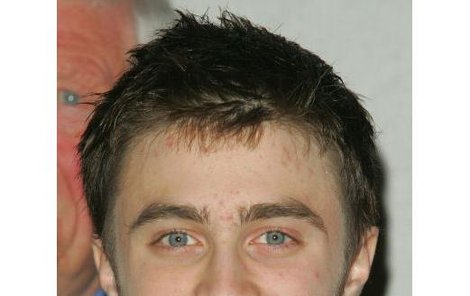 Stejně jako mnoho jeho vrstevníků trpí Daniel Radcliffe akné...