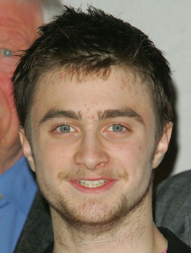 Stejně jako mnoho jeho vrstevníků trpí Daniel Radcliffe akné...