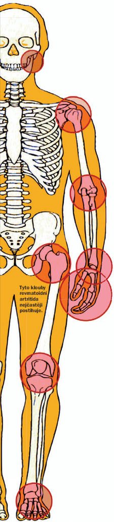 Tyto klouby revmatoidní artritida nejčastěji postihuje.