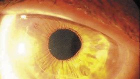 Vyléčený pacient. Po měsíci po operaci je úspěšný výsledek jistý. Oko je ´jako nové´.