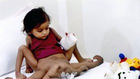 Lakshmi v nemocnici v Bangalore v Indii při čekání na operaci.