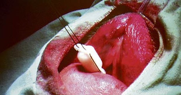 Implantát se zavádí ústní dutinou...
