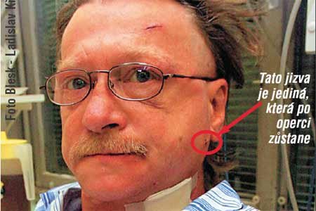 Tato jizva je jediná, která po operci zůstane