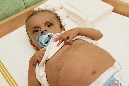 František šest neděl po transplantaci, na bříšku mu je ještě vidět velká jizva