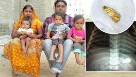 Indické batole Dev Thakor (6 měsíců) spolkl nožík, život mu zachránila až operace!