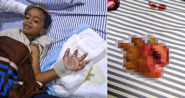 Chlapec (4) si usekl ruku sekačkou na trávu. Lékařům se ji povedlo přišít zpět