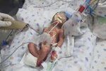Předčasně narozený chlapeček je po chybě lékařů v kritickém stavu.