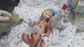 Předčasně narozený chlapeček je po chybě lékařů v kritickém stavu.