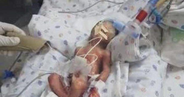 Předčasně narozeného chlapečka prohlásili za mrtvého: Cestou na hřbitov ožil