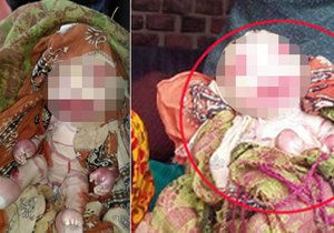 V Indii se narodilo dítě se vzácnou nemocí, kvůli které nemá téměř žádnou kůži.