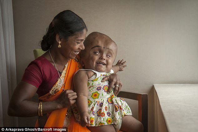 Indická holčička Roona Begum se už operace nedočkala...