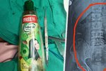 Lékaři v Indii vyoperovali muži (55) z břicha plastovou láhev.