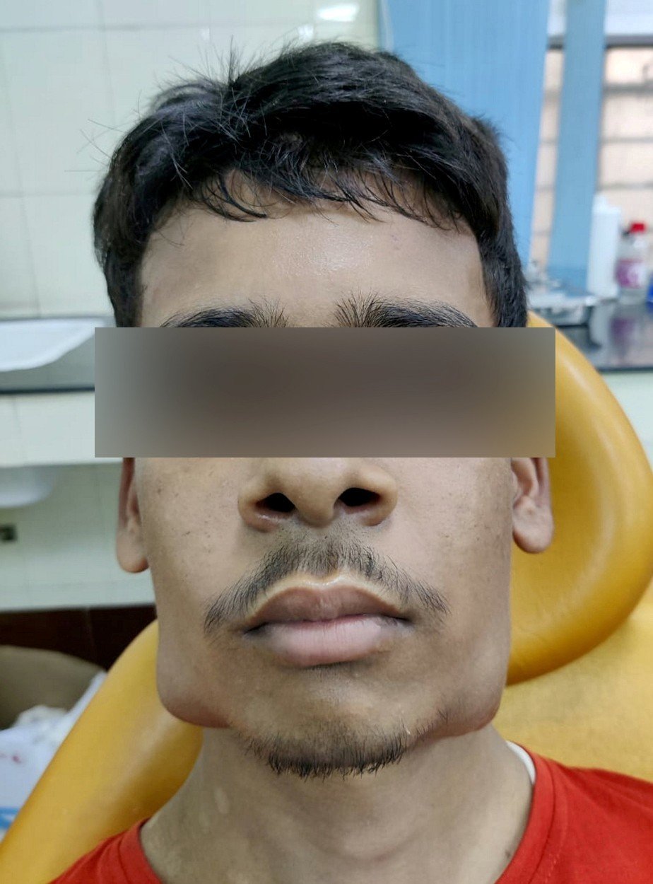 Chlapci (17) z Indie odoperovali nádor u čelist.