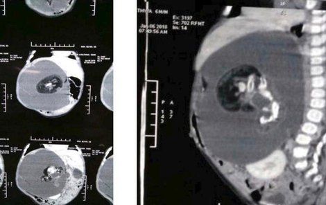 Nenarozeného sourozence z dívenky vyoperovali lékaři.