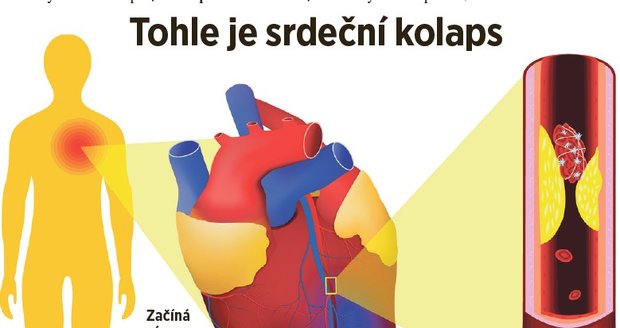 Srdeční kolaps