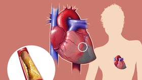Ucpané cévy vedou k vážným onemocněním srdce