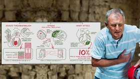 Zabijáci poloviny lidstva v Evropě: Infarkt, mrtvice a plicní embólie! Podívejte se, jak vznikají!