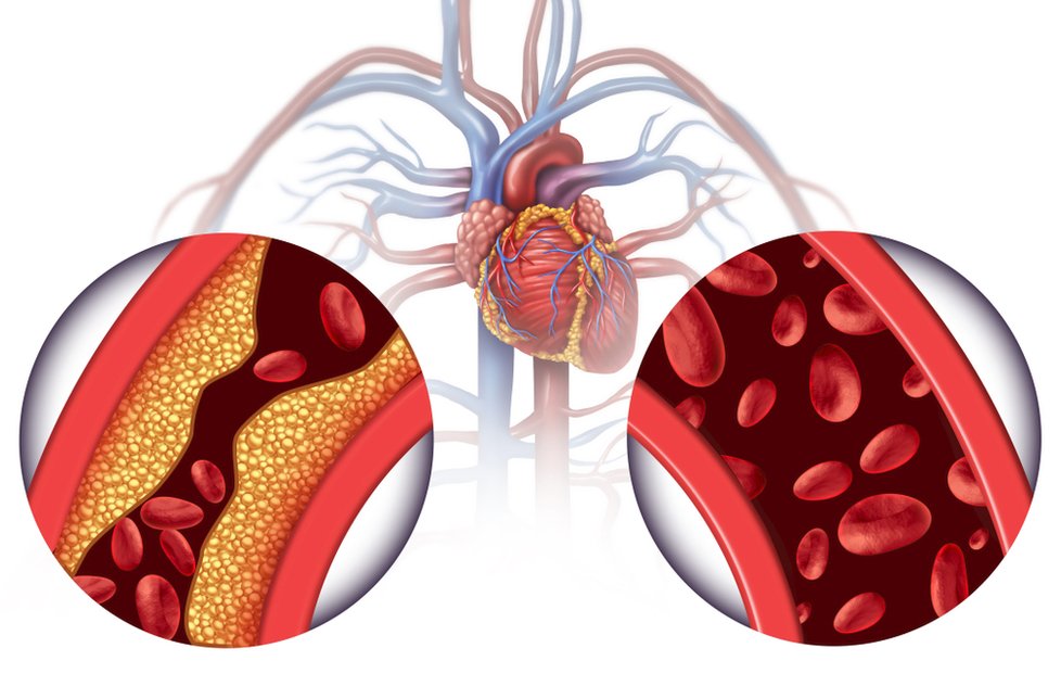 Vysoký cholesterol vede ke kardiovaskulárním chorobám, které ročně zabijí 50 tisíc Čechů (ilustrační foto)