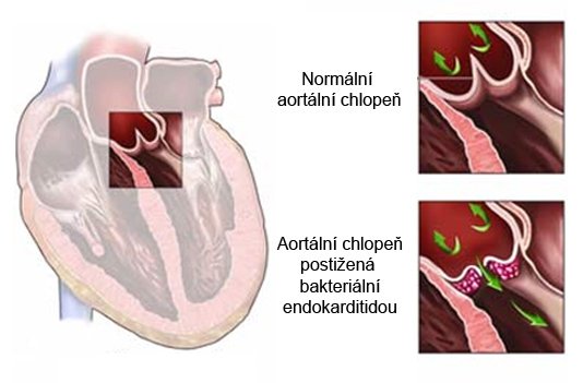 Infekční endokarditida je zánět vnitřního povrchu srdce neboli endokardu, který je způsobený mikroorganismy a postihuje zejména srdeční chlopně.