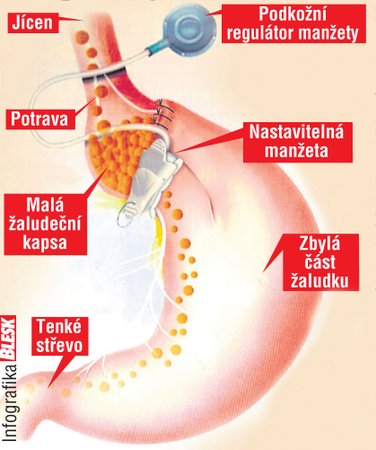 Jak pracuje zabandážovaný žaludek