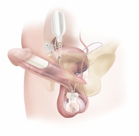 Nafukovací penilní implantát