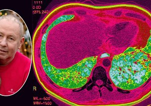 Ivan trpěl vzácnou nemocí plic, na transplantaci jater čekal rok