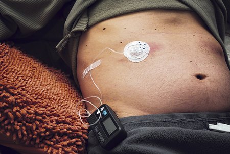 Ivana Rusinu drží při životě podkožně zavedená infuzní pumpa
