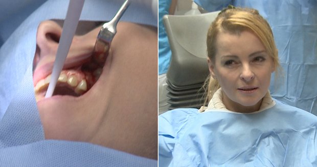 Bartošová nelenila a podstoupila operaci zubů.