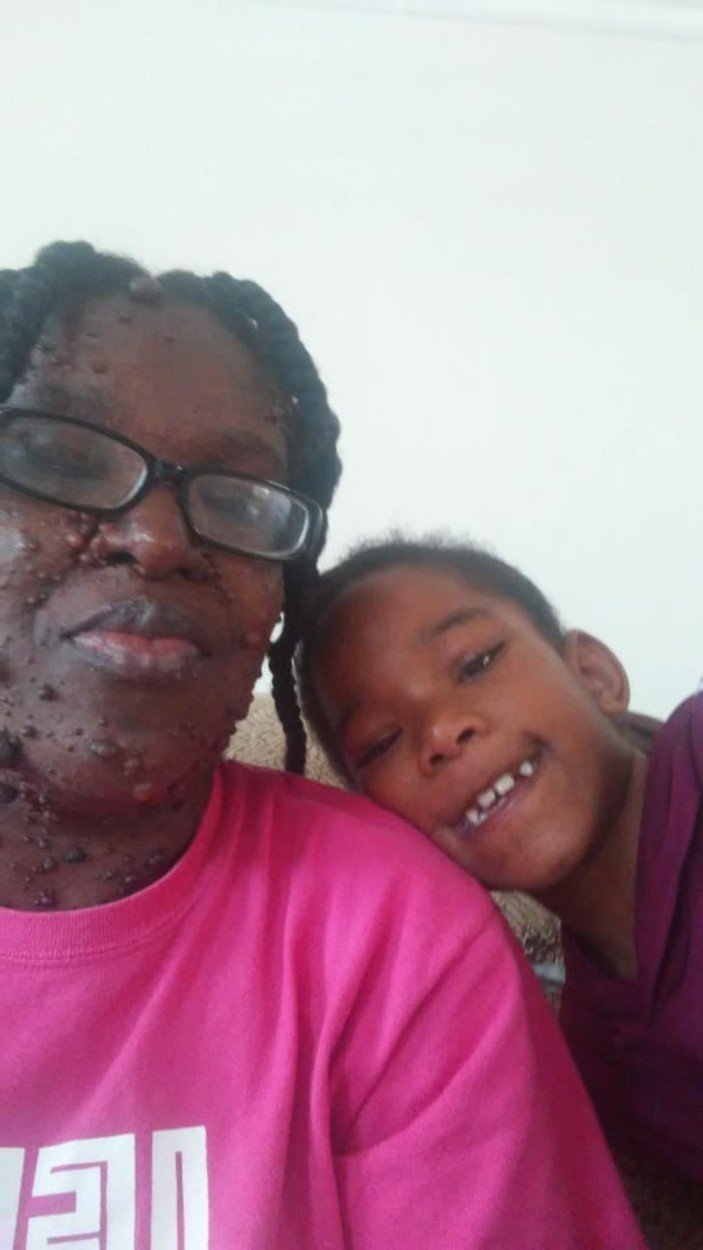 Máma Jamila Gordonová (33) trpí genetickým onemocněním zvaným neurofibromatóza, které způsobuje, že jí na kůži rostou malé a bolestivé nádory.