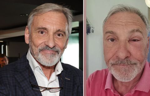 Z prince vorvaněm: Jan Čenský šokoval oteklou tváří! | Blesk.cz