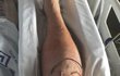 Po operaci se herec probudil s obrovskou jizvou na koleni.
