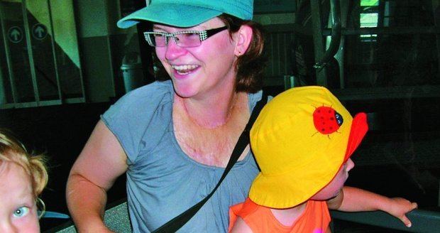 Popálená Jana: Tělem mi projelo 25 000 voltů! Jana (28) má za sebou už třiadvacet operací.