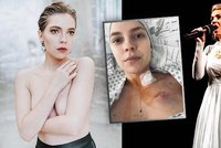 Krásná vítězka Talentmanie Janečková (24) o boji s rakovinou: Konec chemoterapií! Co bude teď?