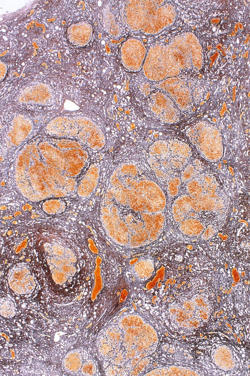 Jaterní cirhóza pod mikroskopem
