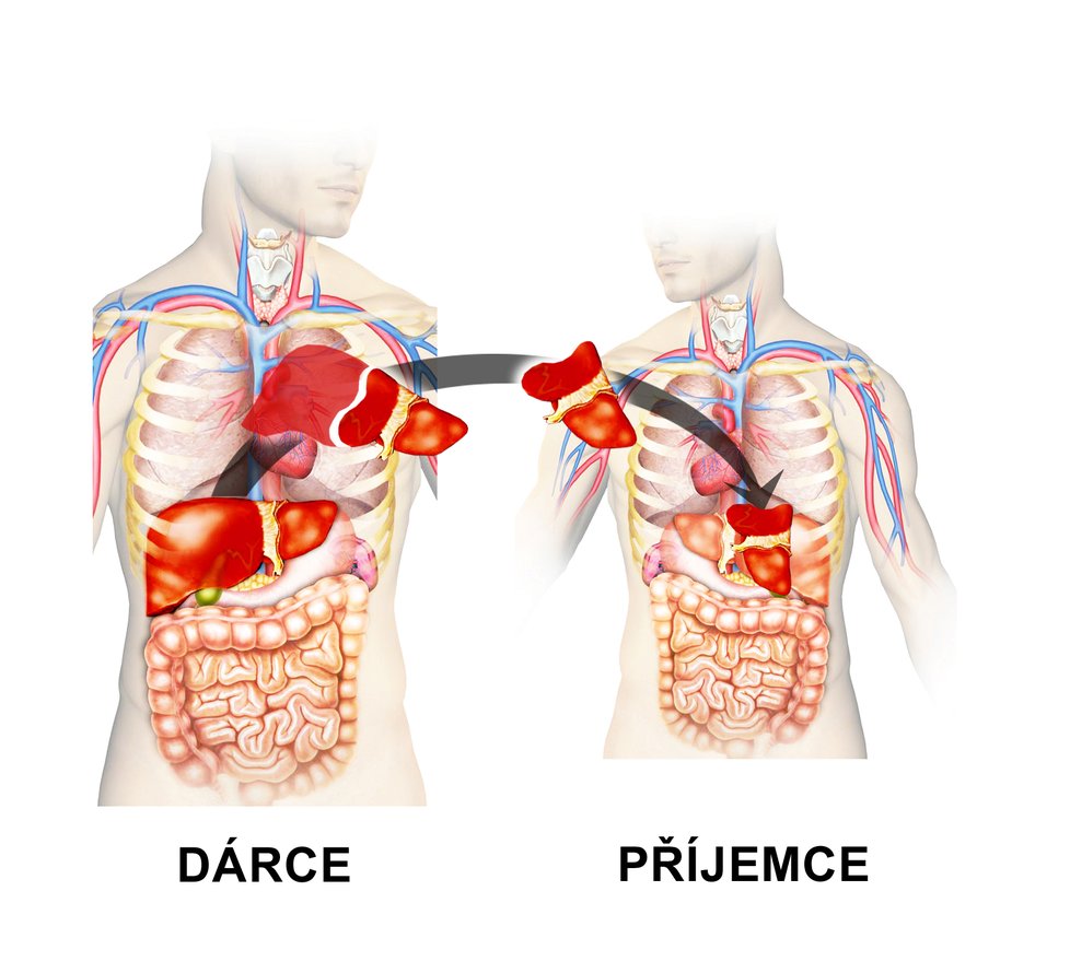 Takto vypadala náročná transplantace.