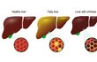 Zdravá játra - Tukem zbytnělá - Postižená cirhózou