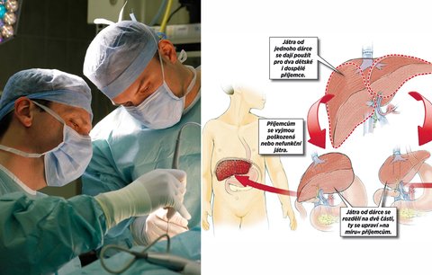 Unikátní transplantace v IKEM: Jedna játra zachránila dvě děti! Poprvé v historii ČR